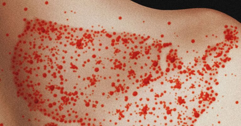 Scientists find measles who are likely to become endemic in the United States in the next 20 years